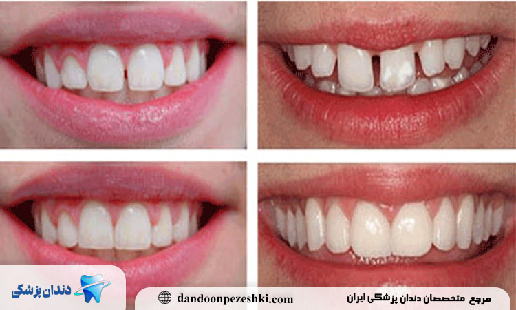 چه کسانی بهترین گزینه برای ارتودنسی دندان فاصله دار هستند؟