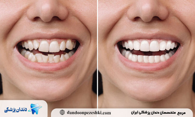 چه کسانی بهترین گزینه برای کامپوزیت دندان هستند؟