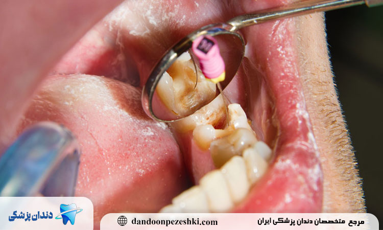 چگونه بهترین متخصص عصب‌کشی را پیدا کنیم؟