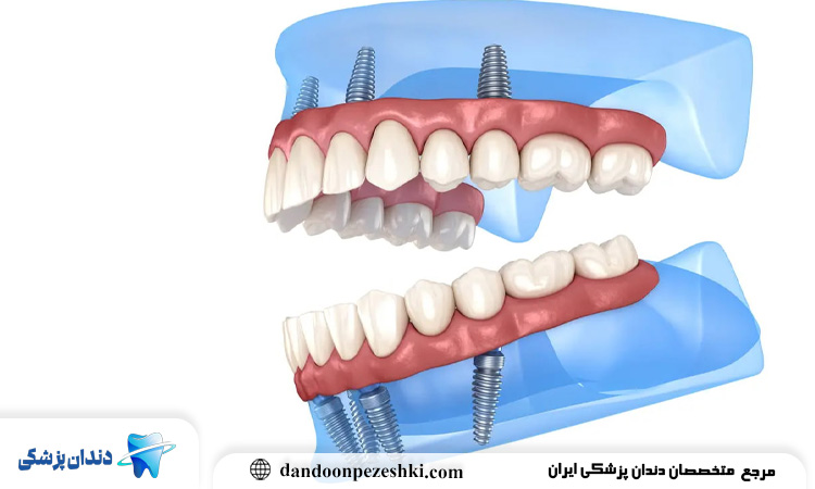 کاشت دندان به چه روش‌هایی انجام می‌شود؟ + مزایا و معایب