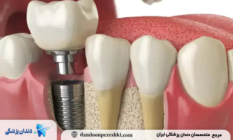 کاشت دندان چیست و چرا یکی از گزینه‌های اصلی جایگزینی دندان‌های از دست‌رفته به شمار می‌رود؟