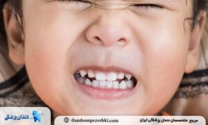 تأثیر دندانقروچه شبانه بر سلامت دهان و فک در بلندمدت