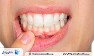 نقش تغذیه و ویتامین‌ها و کمبود آن تحلیل لثه 