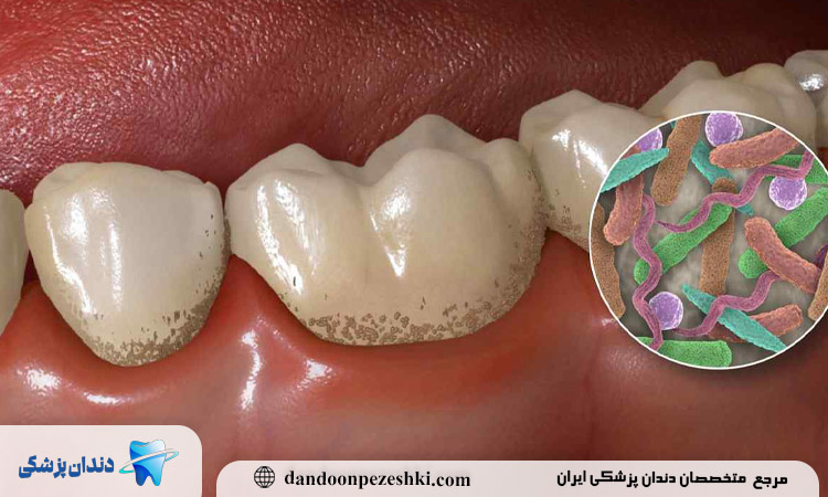 درمان‌های مختلف عفونت دندان چیست و چگونه بر اساس نوع آن انتخاب می‌شوند؟