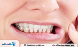 دندان‌قروچه شبانه چیست و چرا اتفاق می‌افتد؟