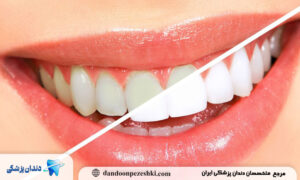 راهکارهای درمانی برای بهبود رنگ دندان بعد از دوره ارتودنسی