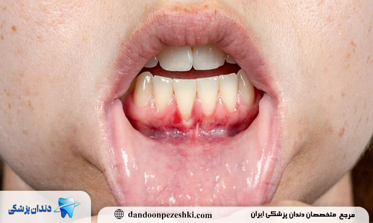 عفونت دندان را چگونه تشخیص داده و درمان کنیم؟