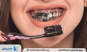 علائم و نشانه‌های آسیب به لثه و عاج دندان ناشی از مصرف زیاد خمیر دندان سفید کننده