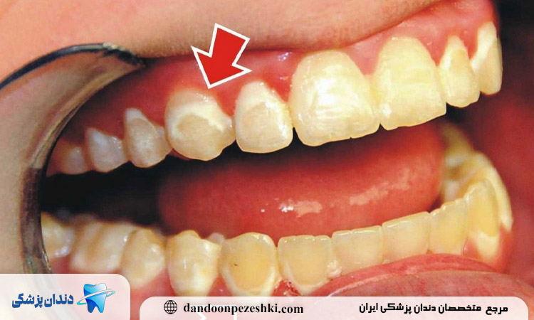 ۵ علامت مهم کمبود کلسیم که ابتدا در دندان‌ها دیده می‌شود