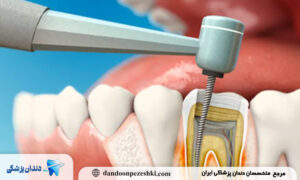 مراحل درمان ریشه توسط متخصص