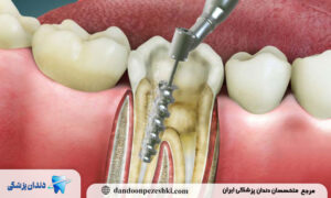 مراقبت‌های بعد از درمان ریشه دندان