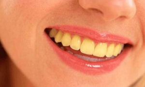 مهم ترین راه های پیشگیری از تغییر رنگ دندان در طول درمان ارتودنسی چیست؟