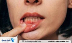 مکمل‌های مفید برای سلامت لثه در کنار تغذیه مناسب