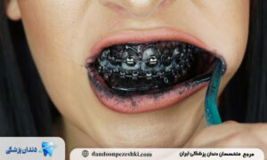 میزان مجاز استفاده از خمیردندان سفیدکننده چقدر است؟