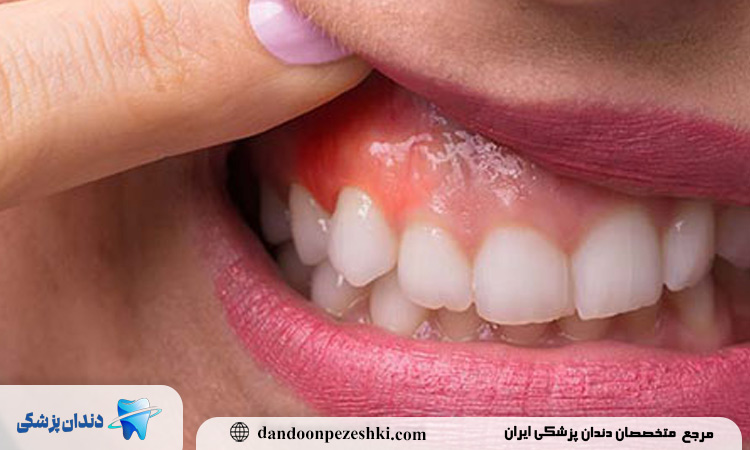 نقش تغذیه در پیشگیری از تحلیل لثه