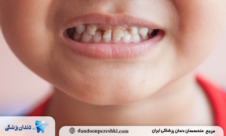 ۳. پوسیدگی زودرس و مکرر حتی با رعایت بهداشت