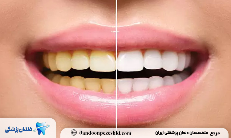 چرا دندان‌ها بعد از ارتودنسی تغییر رنگ می‌دهند و راه پیشگیری چیست؟