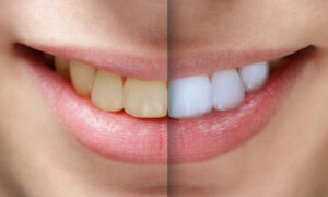 چطور براکت‌های ارتودنسی می‌توانند باعث تغییر رنگ شوند؟