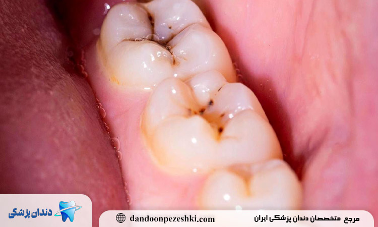 چگونه از بروز مشکلات دندانی ناشی از کمبود کلسیم پیشگیری کنیم؟