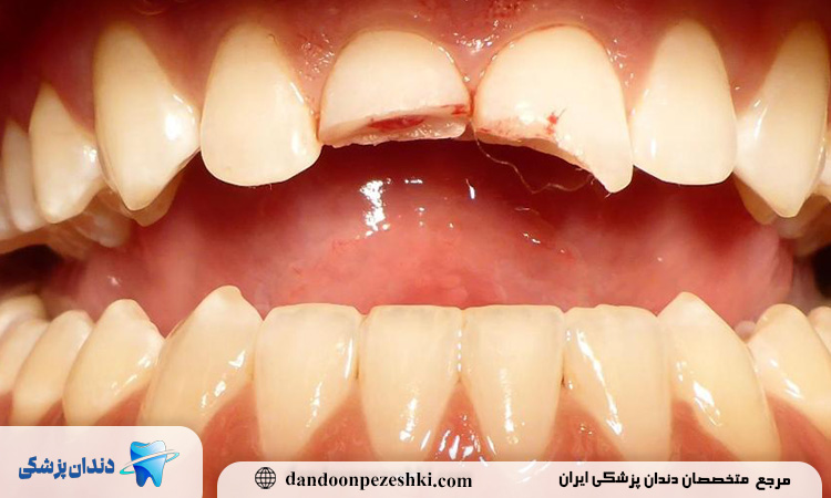 ۵ روش نوین در ترمیم دندان‌های شکسته بدون نیاز به جراحی