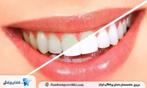 چگونه بدون بلیچینگ، رنگ طبیعی دندان‌ها را حفظ کنیم؟