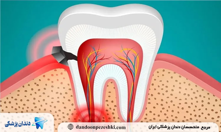 دندان درد عصبی