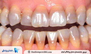 راهکارهای ساده روزمره برای حفظ رنگ طبیعی دندان‌