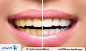 چه عواملی باعث تغییر رنگ دندان‌ها می‌شوند؟