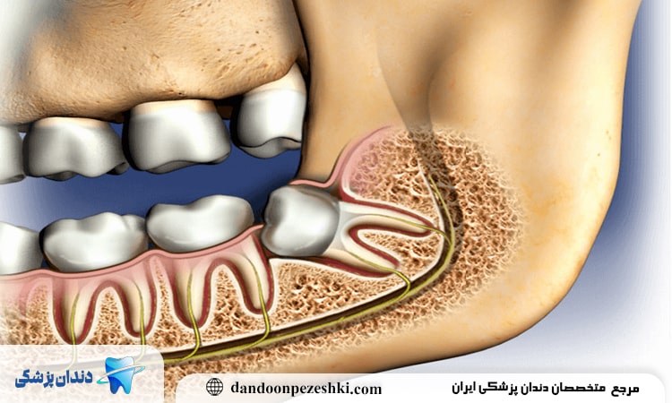 مشکلات فشار دندان عقل