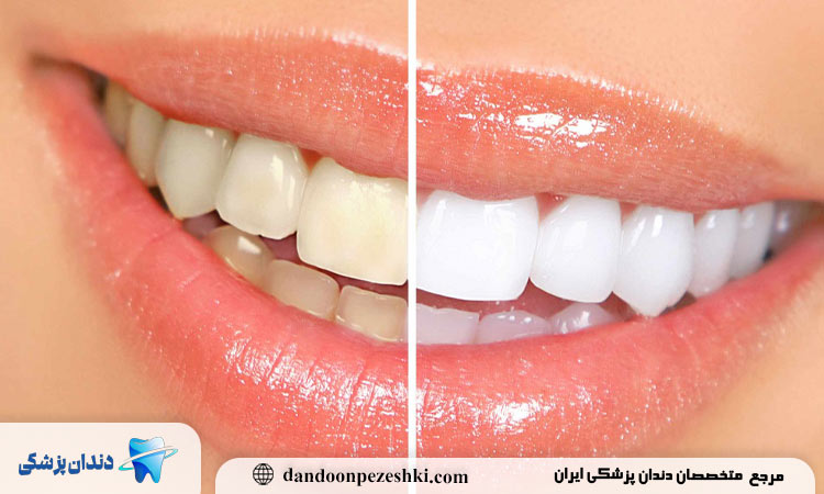 چگونه رنگ طبیعی دندان‌ها را بدون بلیچینگ حفظ کنیم؟