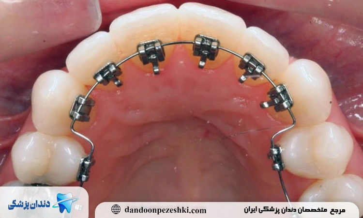 آیا ارتودنسی غلط قابل درمان است