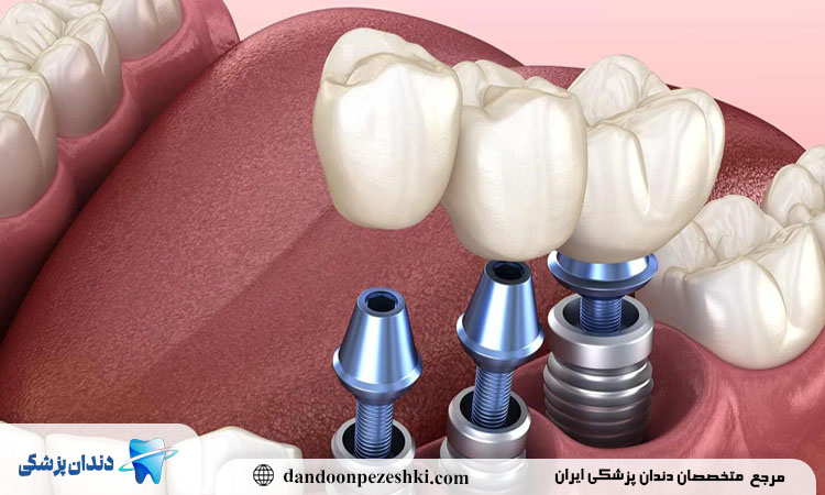 مراحل ایمپلنت در بلوار فردوس تهران