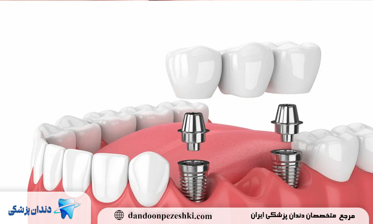 دکتر ایمپلنت دندان در بلوار فردوس