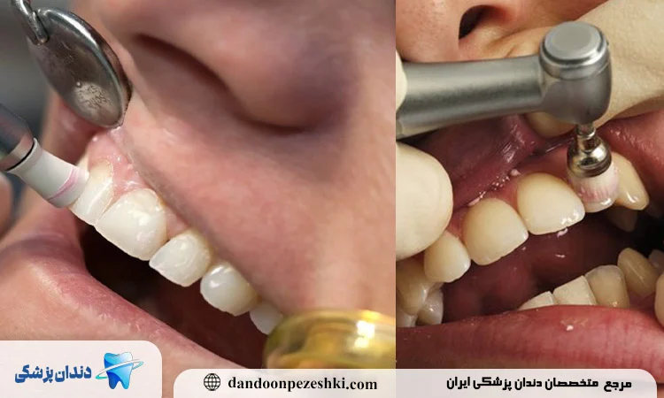 چه زمانی پولیش کامپوزیت ضروری است