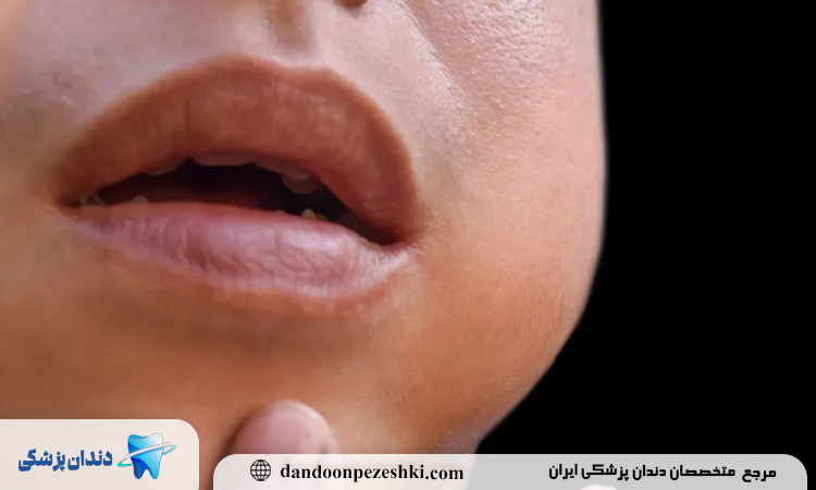 نکات کاهش ورم صورت بعد از جراحی دندان