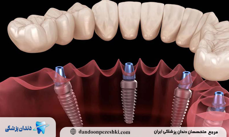 دکتر ایمپلنت در بلوار فردوس