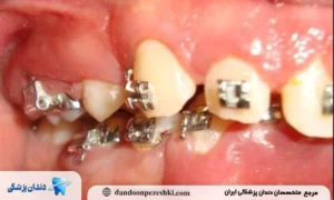 عوارض ارتودنسی اشتباه