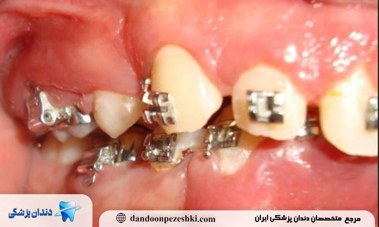 عوارض ارتودنسی اشتباه