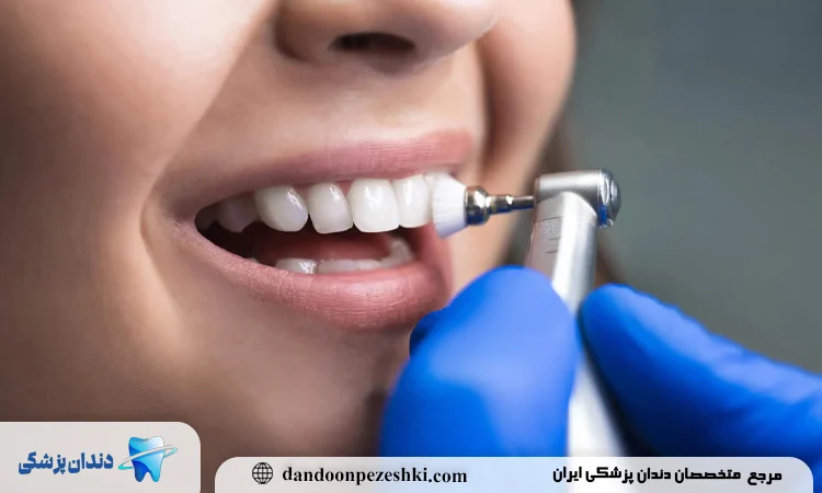 فواید پولیش کامپوزیت دندان