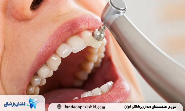 مراحل انجام پولیش کامپوزیت دندان ها