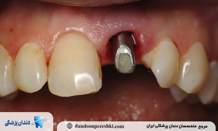مراحل ایمپلنت در بلوار فردوس