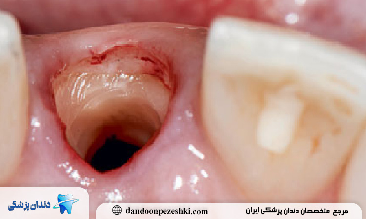 چگونگی تقویت لثه بعد از کشیدن دندان