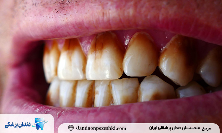 سیگار و سلامت دهان