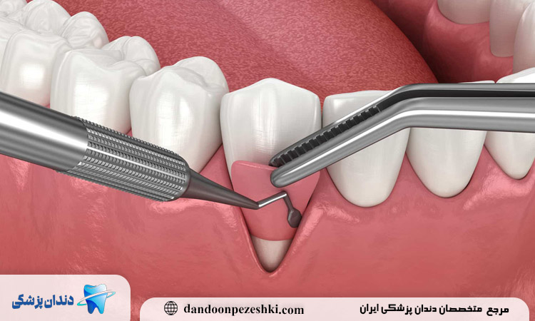 مزایای جراحی لثه چیست