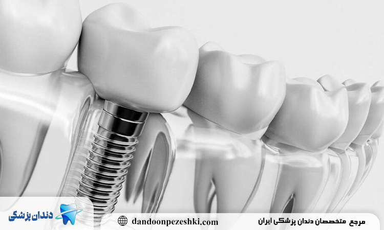 ایمپلنت در پونک