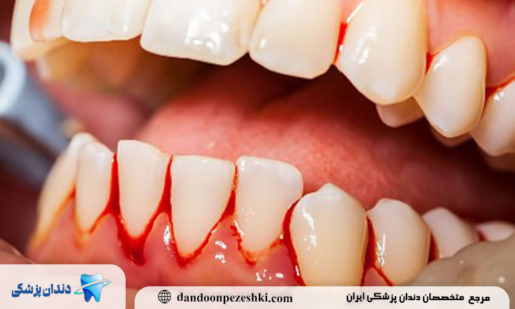 نحوه درمان خونریزی لثه