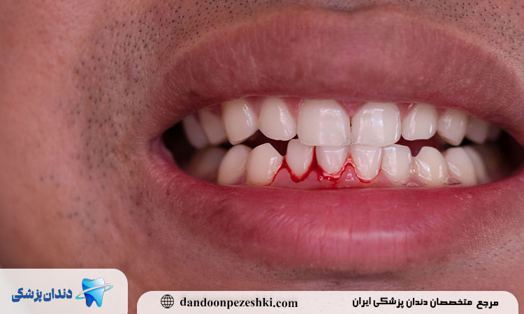 خونریزی لثه