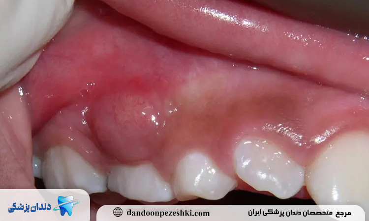 قرص برای عفونت دندان