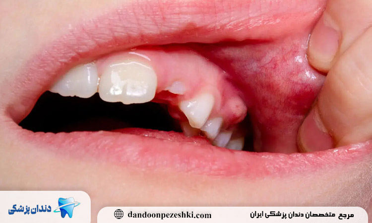 بهترین قرص برای عفونت دندان