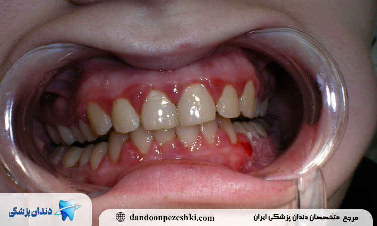 نحوه درمان خونریزی لثه